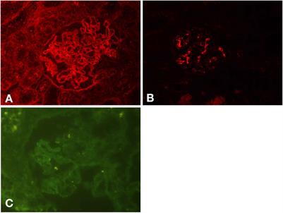 Case Report: Coexistence of Anti-Glomerular Basement Membrane Disease, Membranous Nephropathy, and IgA Nephropathy in a Female PatientWith Preserved Renal Function